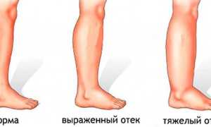 Отеки при гепатите С