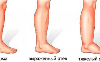 Отеки при гепатите С