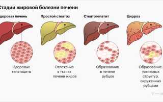 Ожирение повышает шанс цирроза печени