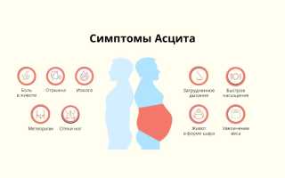 Асцит при гепатите С