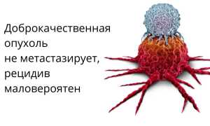 Доброкачественная и злокачественная опухоли