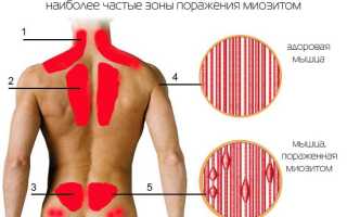Миозит мышц спины