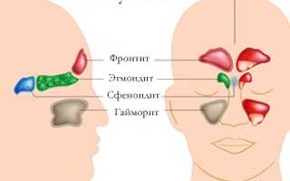 Фронтит – симптомы и лечение в домашних условиях