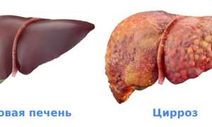 Цирроз печени