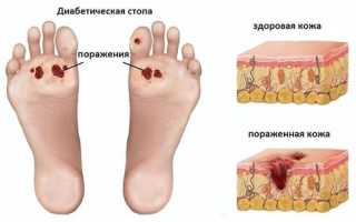 Диабетическая стопа: симптомы и лечение в начальной и запущенной стадии