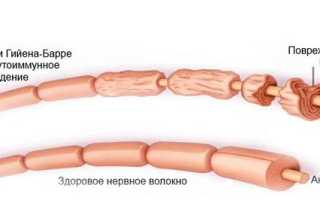 Синдром Гийена-Барее – симптомы и лечение