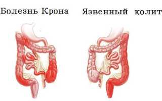 Болезнь Крона – симптомы, диагностика и лечение