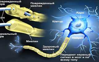 Ретробульбарный неврит зрительного нерва