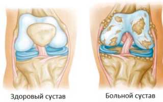 Реактивный артрит – симптомы и лечение