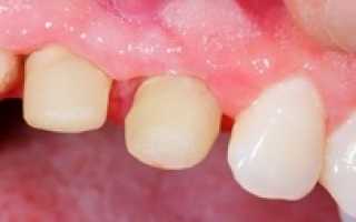 Периостит – что это такое? Причины, симптомы и лечение