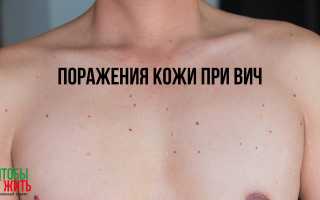 Проблемы с кожей при ВИЧ: симптомы и лечение
