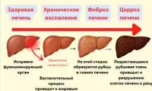 Стадии хронического гепатита C