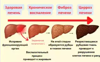 Стадии хронического гепатита C