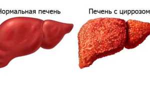 Выявлен ген, связанный с развитием фиброза печени