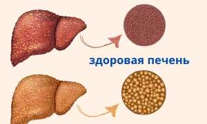 Гепатостеатоз