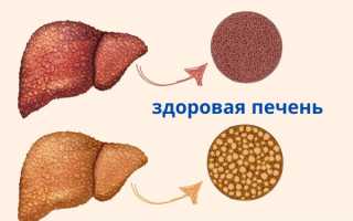 Гепатостеатоз