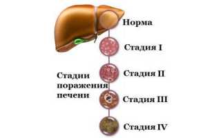 Фиброз печени 4 степени и гепатит С