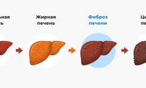 Декомпенсированный цирроз печени