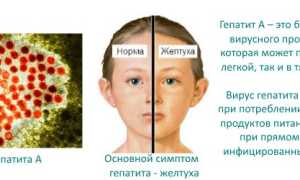 Заразившихся гепатитом С онкобольных детей превышает сотню