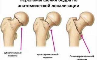 Перелом шейки бедра у пожилых