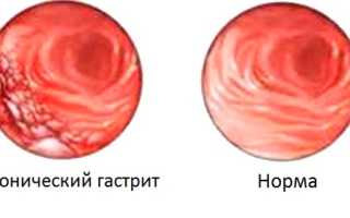 Хронический гастрит – симптомы и лечение