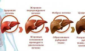 Гепатит С и цирроз: как жить и чем лечить