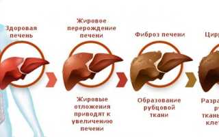 Гепатит С и цирроз: как жить и чем лечить