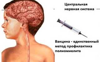 Полиомиелит – что это такое? Симптомы и лечение, прогноз