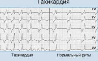 Тахикардия сердца – что это такое, и как лечить?