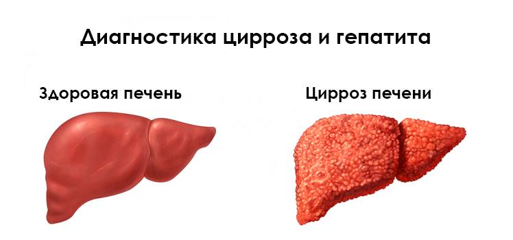 Диагностика цирроза и гепатита
