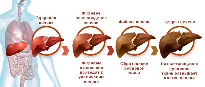 Стадии и степени повреждения печени