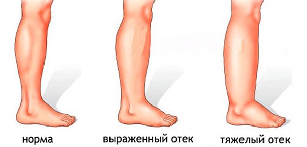 Отеки при ВГС