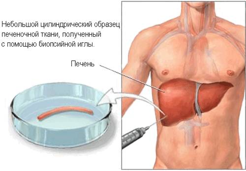 Иллюстрация образца печени, взятого для юиопсии