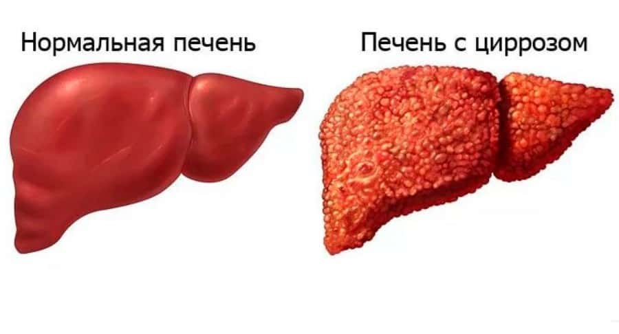 фиброз f4 цирроз