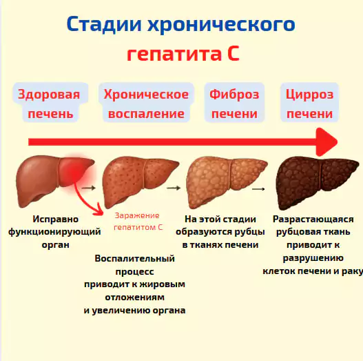 Стадии хронического гепатита C