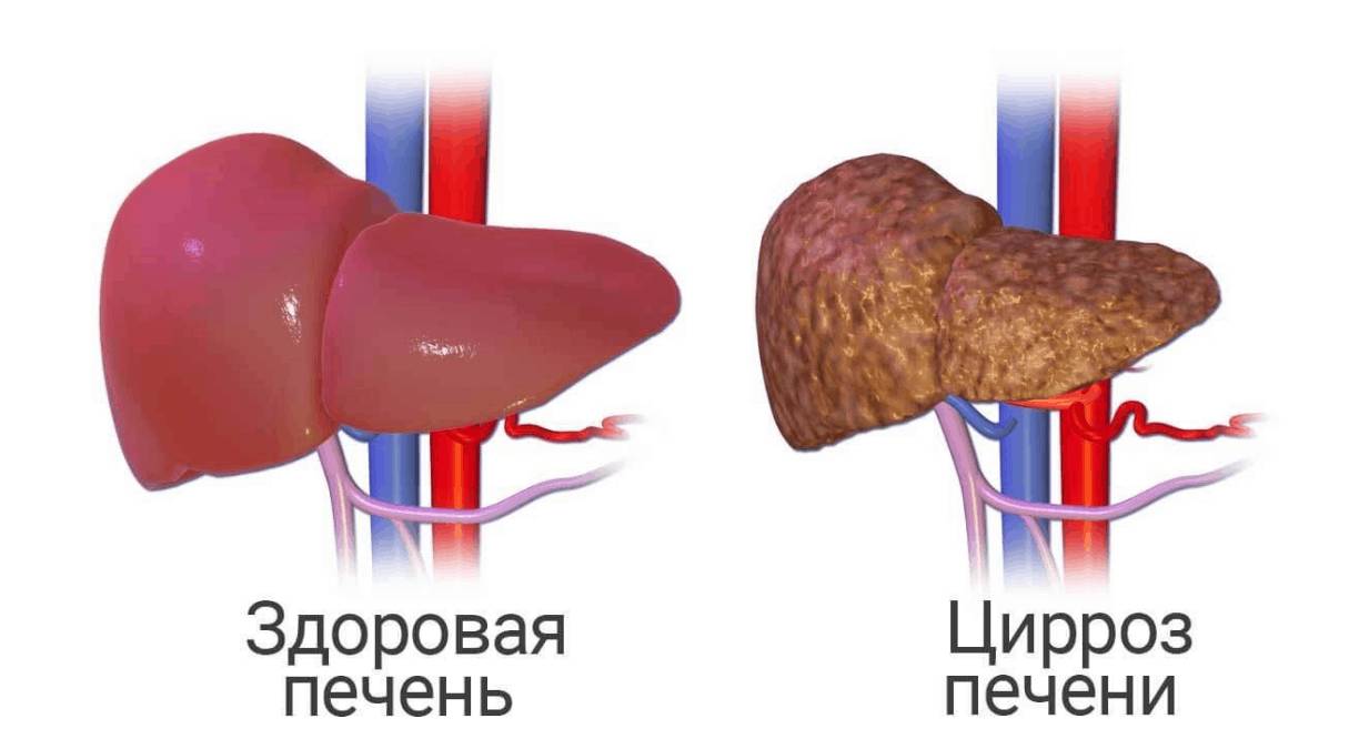 Цирроз печени