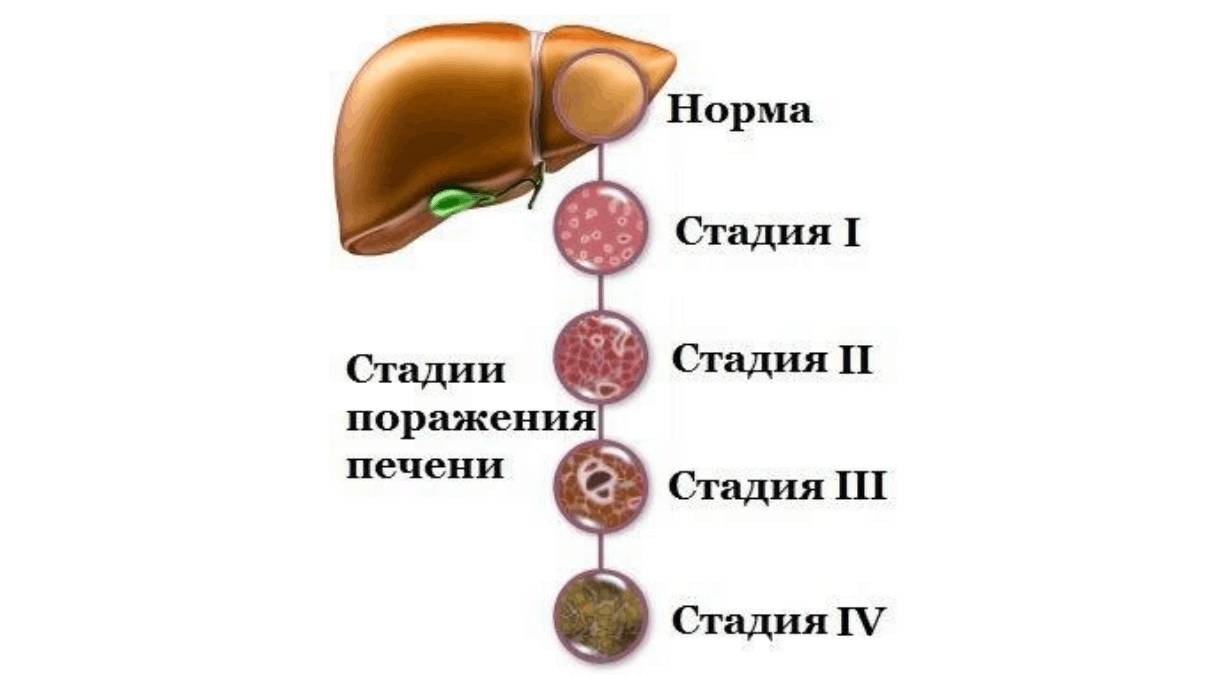 Стадии фиброза